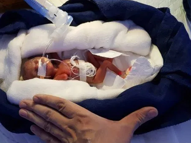 Smallest Premature Baby With Only 0.5% Survival Miraculously Lives!