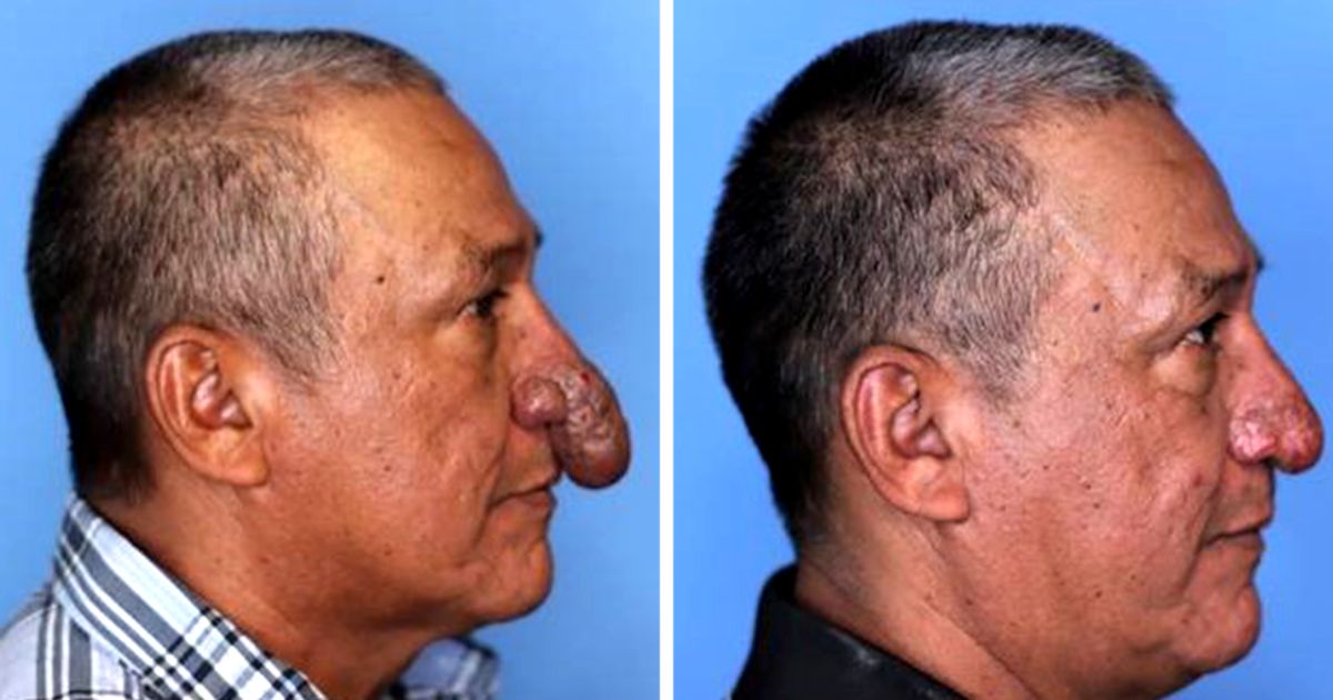 Painter With Deformed Nose Has Amazing Transformation After A Doctor Saw Him In His Yard