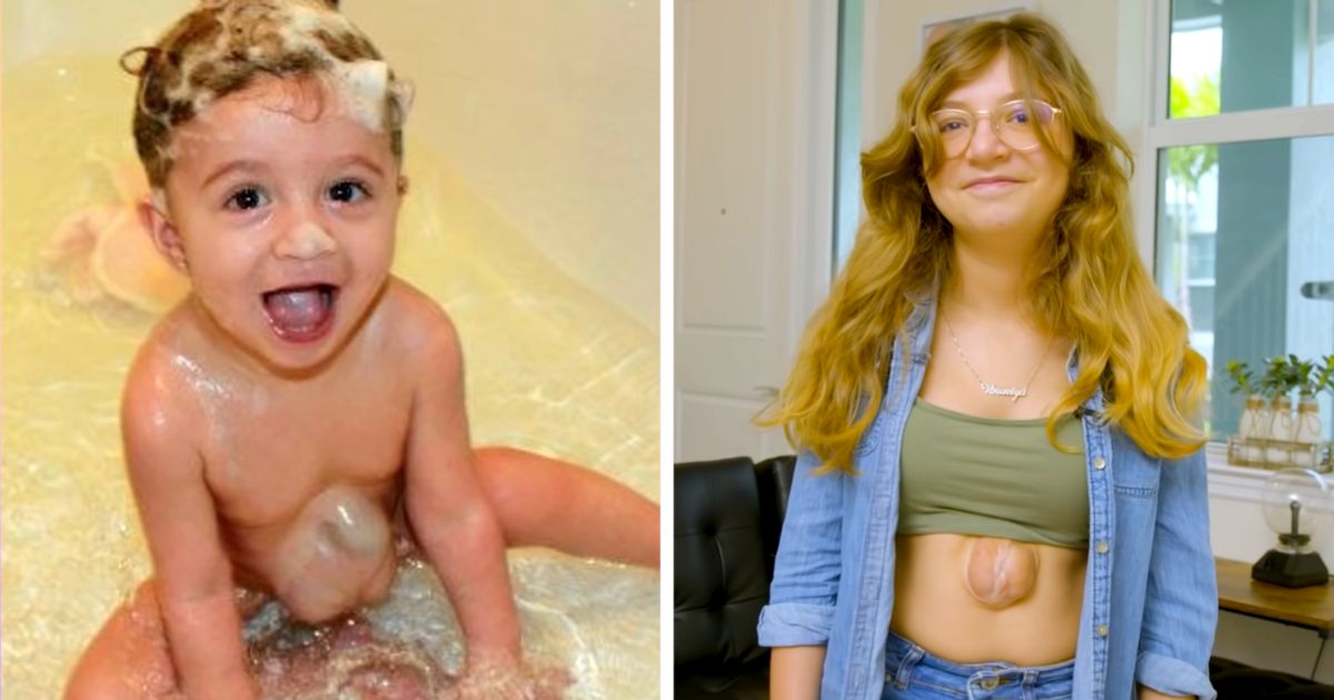 Girl Born With Heart Outside Chest Is A True Fighter And Inspiration